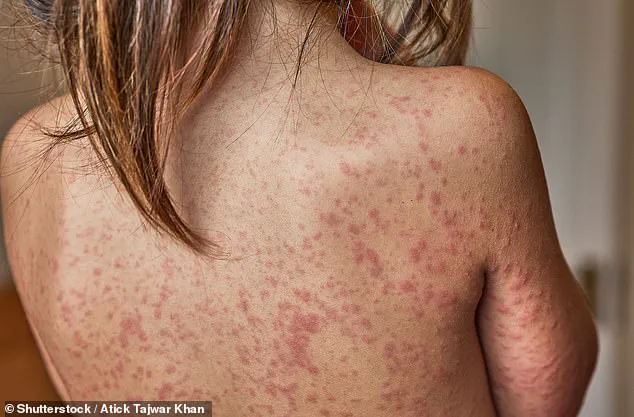 The Surprising Aftermath of a Common Childhood Illness