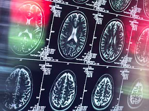 Late-Breaking Discovery: Johns Hopkins Unveils Advanced MRI Technique to Predict Dementia Years Before Symptoms