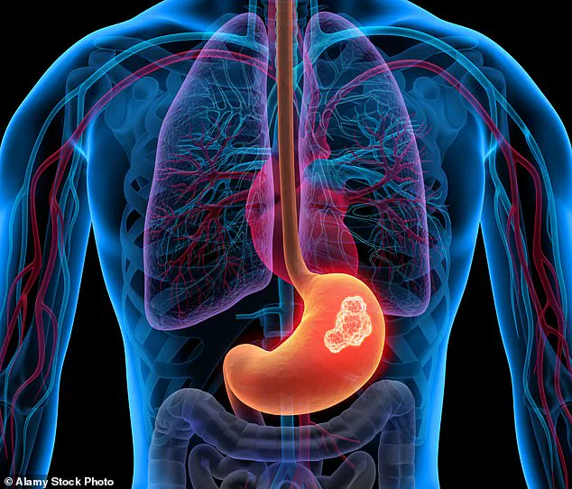Urgent Warning: Persistent Heartburn May Signal Hidden Dangers, GP Warns