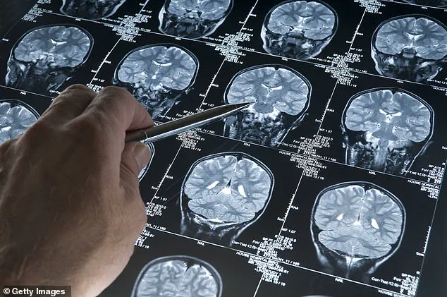 New Study Reveals Deeper Neurological and Psychological Roots of Misophonia, According to UC Berkeley and Hashir International Research