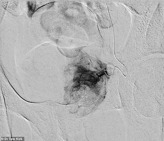 Silent Epidemic: The Growing Challenge of Benign Prostatic Hyperplasia in Aging Populations