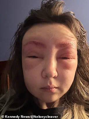 Vancouver Woman's Severe Allergic Reaction to Eyebrow Tinting Leaves Her Face Swollen and Resembling an 'Alien'