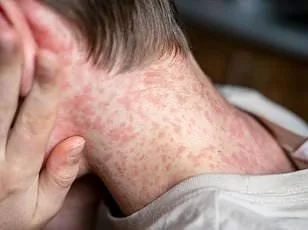 CDC Issues Level 2 Travel Advisory for Bolivia as Chikungunya Cases Surge