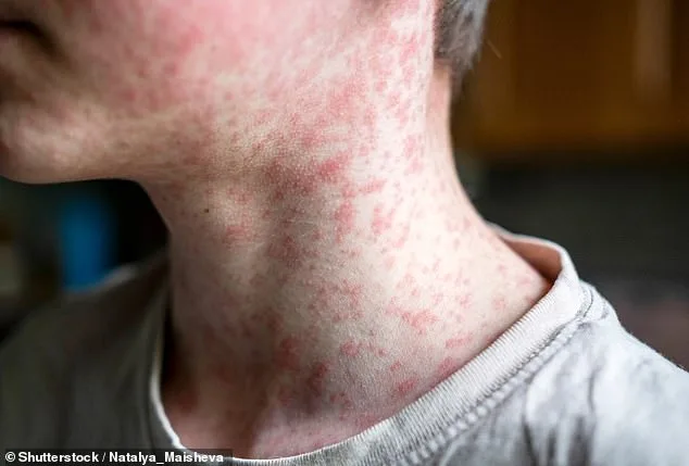 Measles Cases Surge to Decades-High Levels, CDC Warns of Risk of Losing Elimination Status
