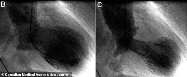 Broken Heart Syndrome: A Stress-Triggered Condition That Mimics Heart Attacks