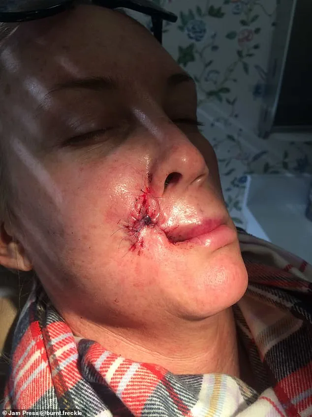 A Mother's Relentless 20-Year Battle Against Recurring Skin Cancer