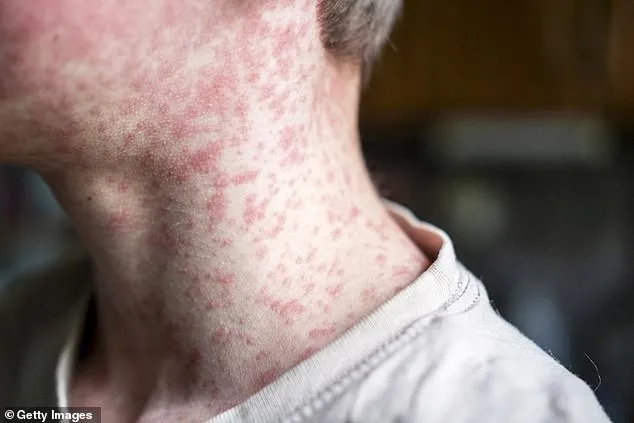 Deadly Secret of Measles Resurges in U.S., Threatening Children with Rare Brain Disease