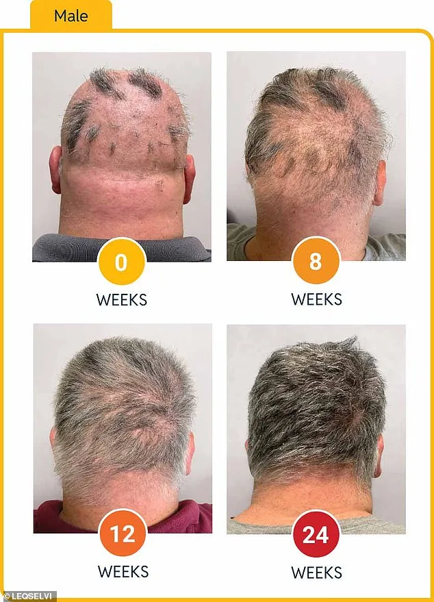 UK Approves New Medication for Alopecia Areata