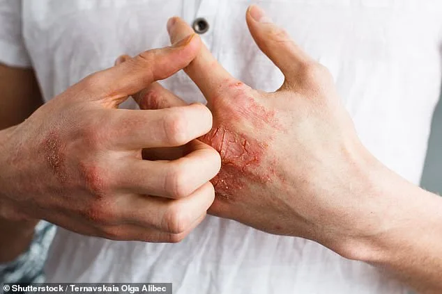 FDA Approves Icotyde: Breakthrough Oral Treatment for Psoriasis