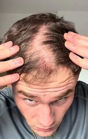 Desperate for a Solution: How Hair Fibres Changed Rob James' Life