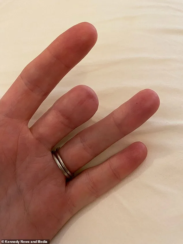 Faint Brown Line Under Fingernail Warns of Deadly Cancer, Experts Urge Vigilance
