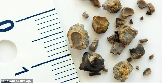 Kidney Stones on the Rise: Soaring Rates Among Younger Americans