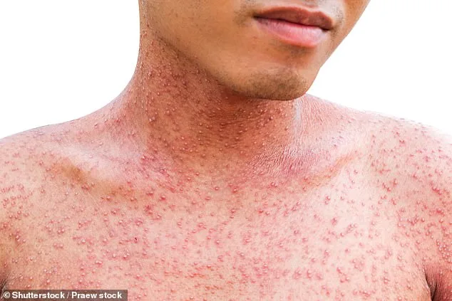 Surge in Flea-Borne Typhus Cases Sparks Public Health Emergency in Los Angeles