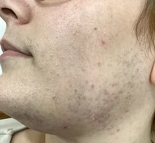 The Hidden Burden of Hirsutism: How PCOS Leaves Women Battling Unwanted Facial Hair and Emotional Struggles