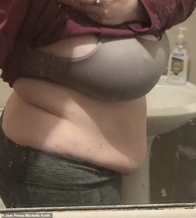 Michelle Keith's Lipoedema Journey: From Postpartum Pain to Chronic Struggle