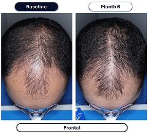 Veradermics' extended-release minoxidil delivers four times the hair regrowth of standard treatments.