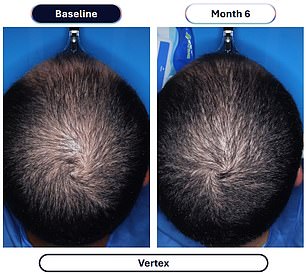 Veradermics' extended-release minoxidil delivers four times the hair regrowth of standard treatments.