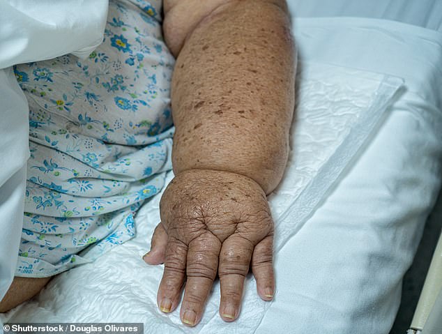 New trial confirms skipping arm gland removal is safe for many breast cancer patients.